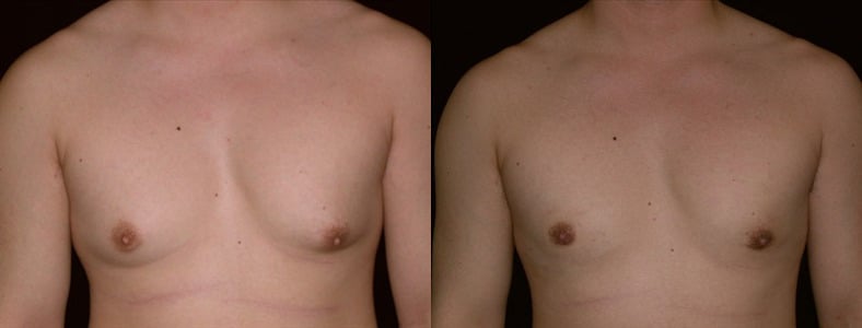 Gynecomastia Patient 12 Before & After