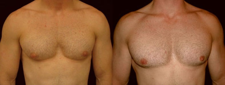 Gynecomastia Patient 7 Before & After