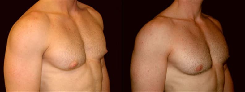 Gynecomastia Patient 7 Before & After Details