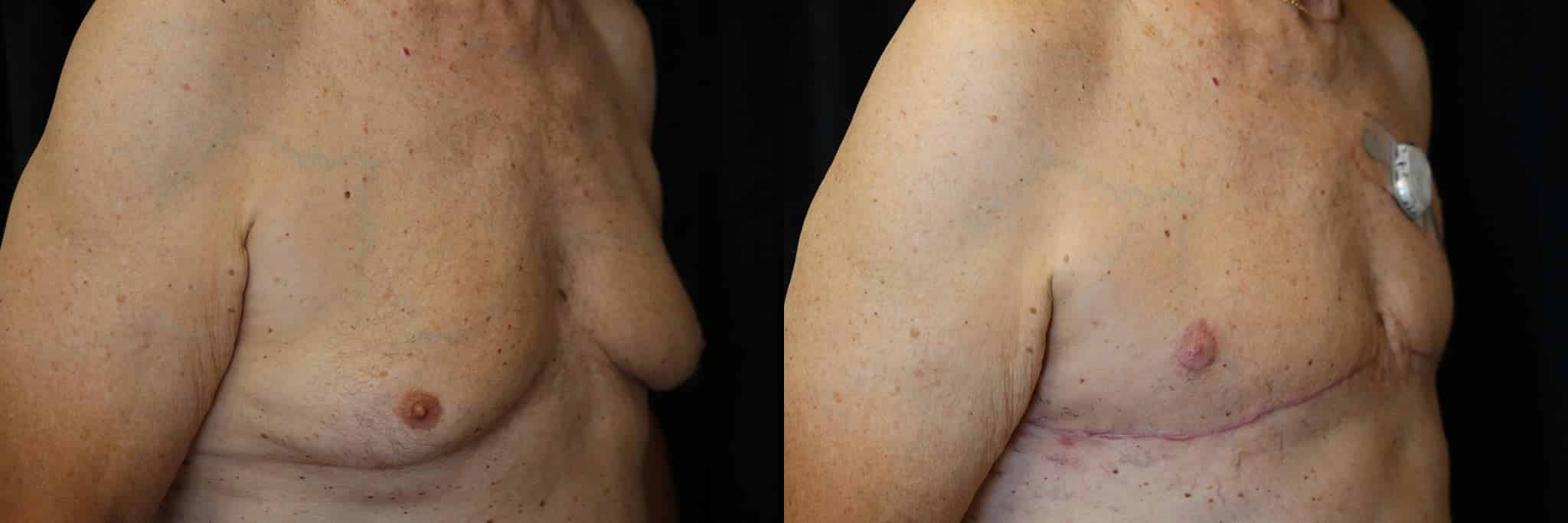 Gynecomastia Patient 10 Before & After Details