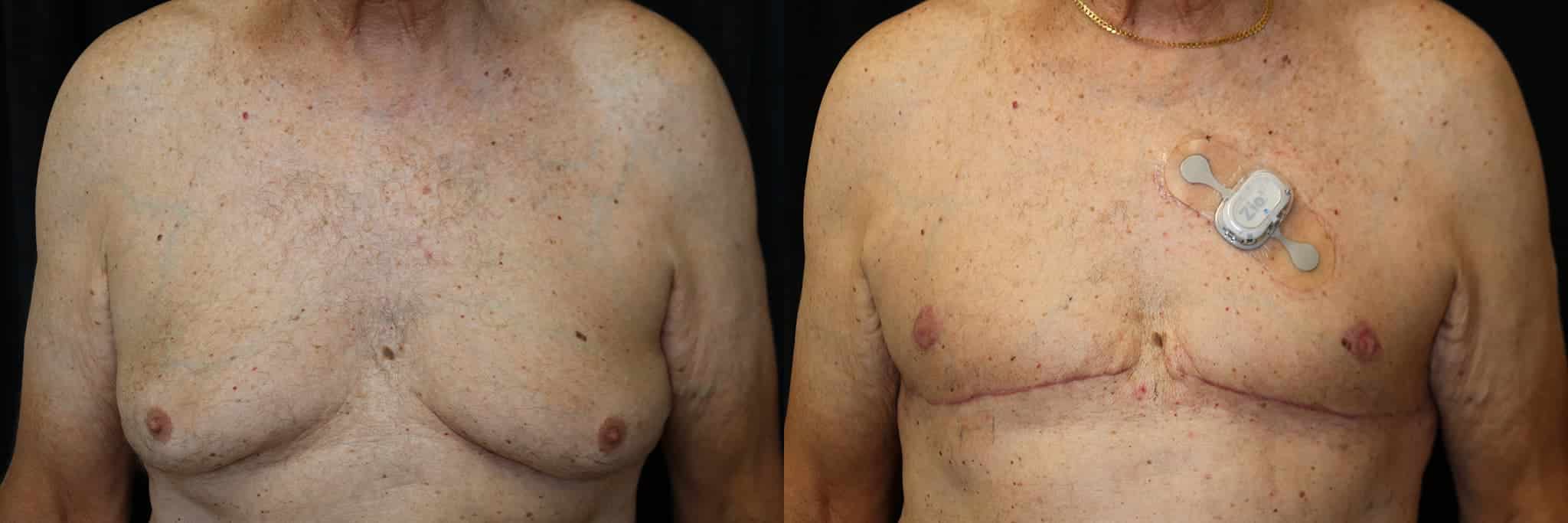 Gynecomastia Patient 10 Before & After