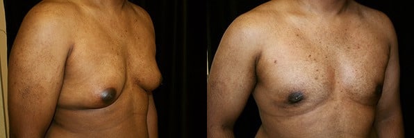 Gynecomastia Patient 2 Before & After Details