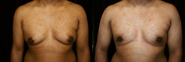 Gynecomastia Patient 2 Before & After