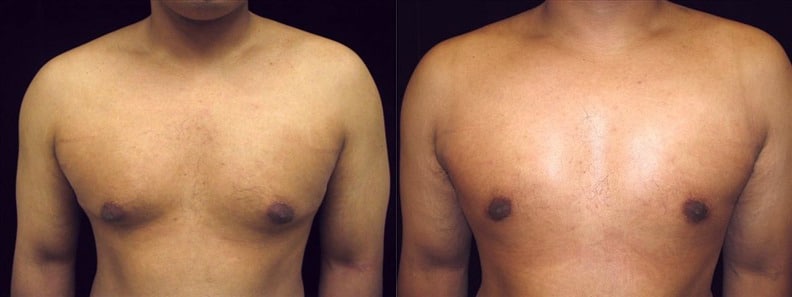 Gynecomastia Patient 13 Before & After