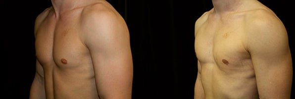 Gynecomastia Patient 9 Before & After Details