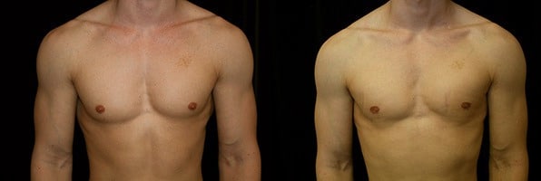 Gynecomastia Patient 9 Before & After