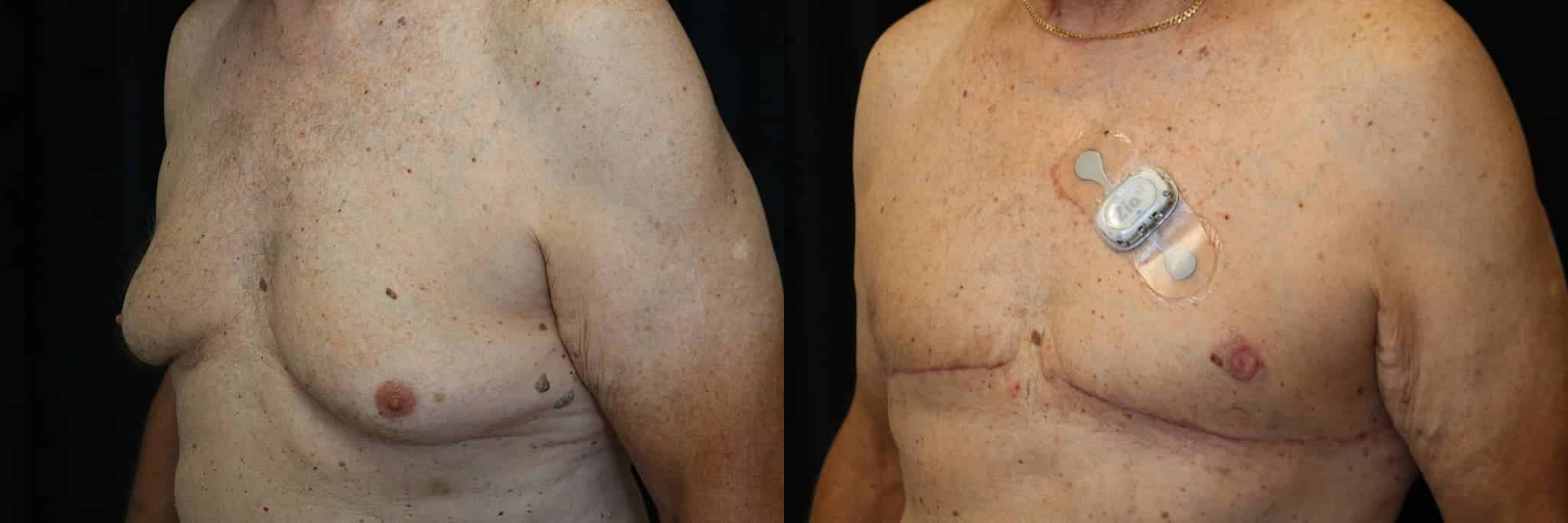 Gynecomastia Patient 10 Before & After Details