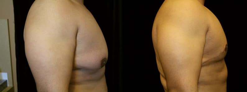 Gynecomastia Patient 3 Before & After Details