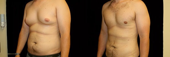 Gynecomastia Patient 17 Before & After Details