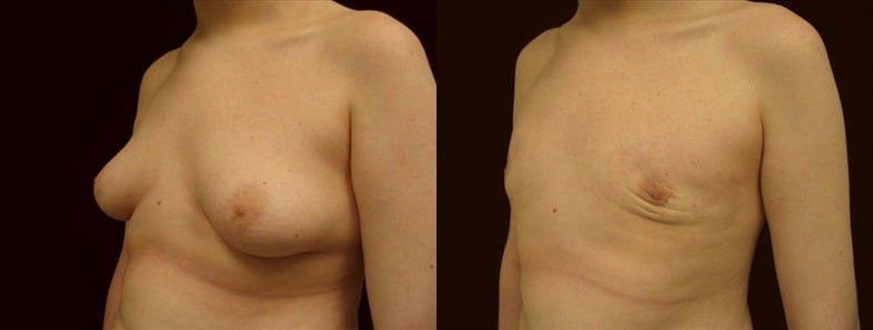 Gynecomastia Patient 9 Before & After