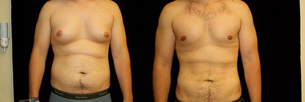 Gynecomastia Patient 17 Before & After