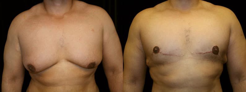 Gynecomastia Patient 3 Before & After