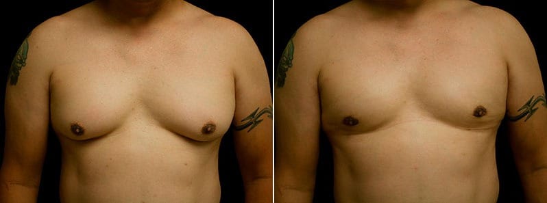 Gynecomastia Patient 16 Before & After