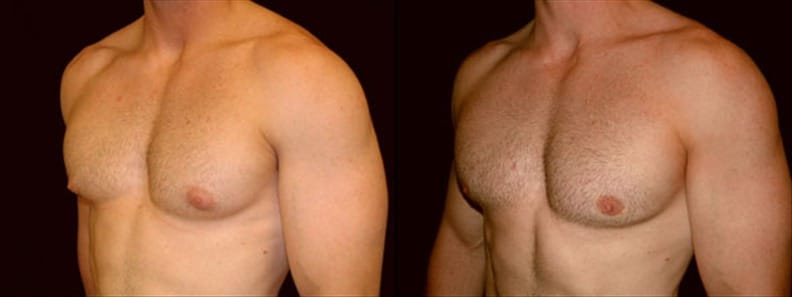 Gynecomastia Patient 7 Before & After Details