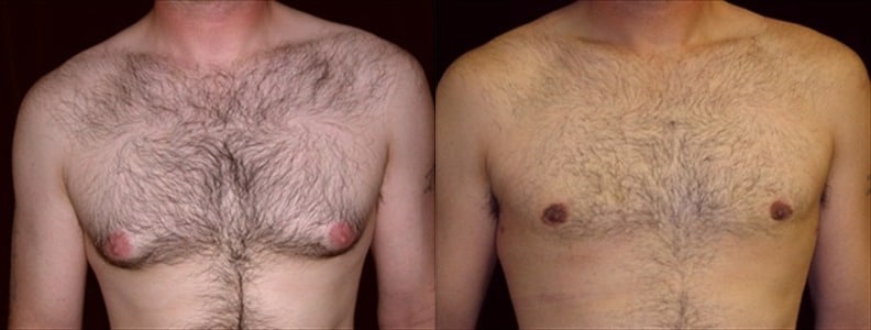 Gynecomastia Patient 3 Before & After