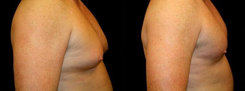 Gynecomastia Patient 20 Before & After Details