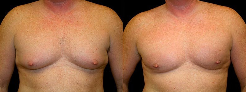 Gynecomastia Patient 20 Before & After