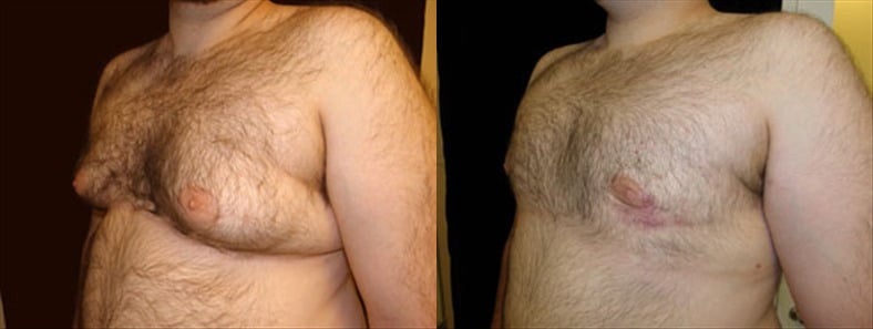 Gynecomastia Patient 12 Before & After Details