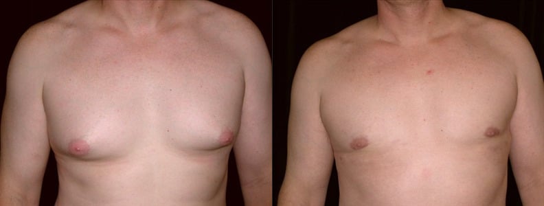 Gynecomastia Patient 8 Before & After