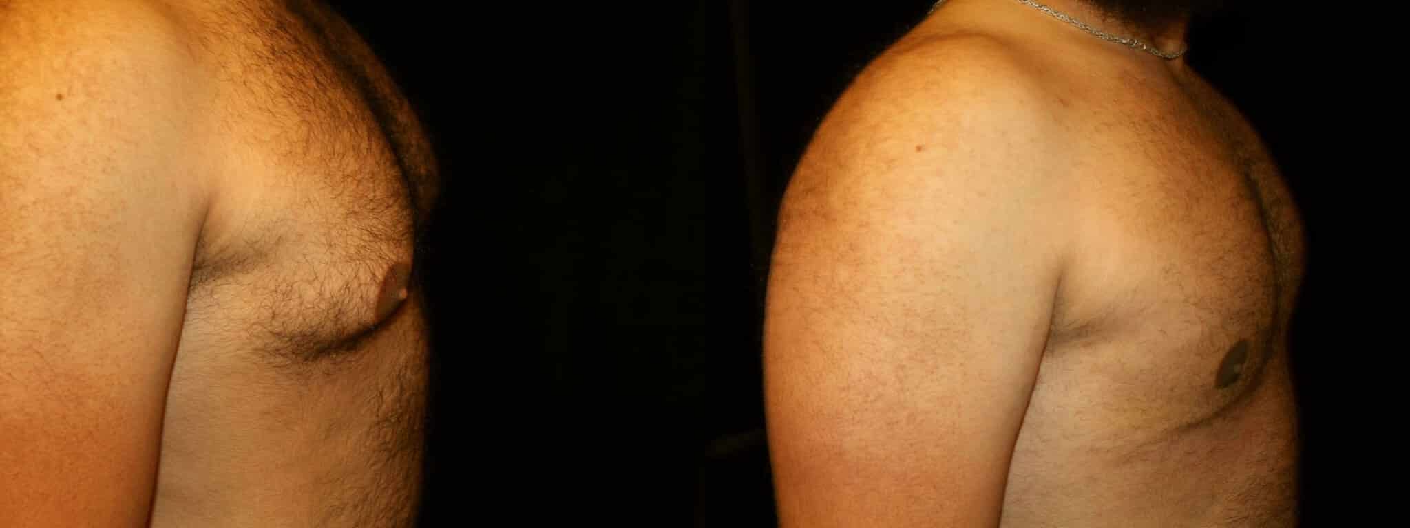 Gynecomastia Patient 20 Before & After Details