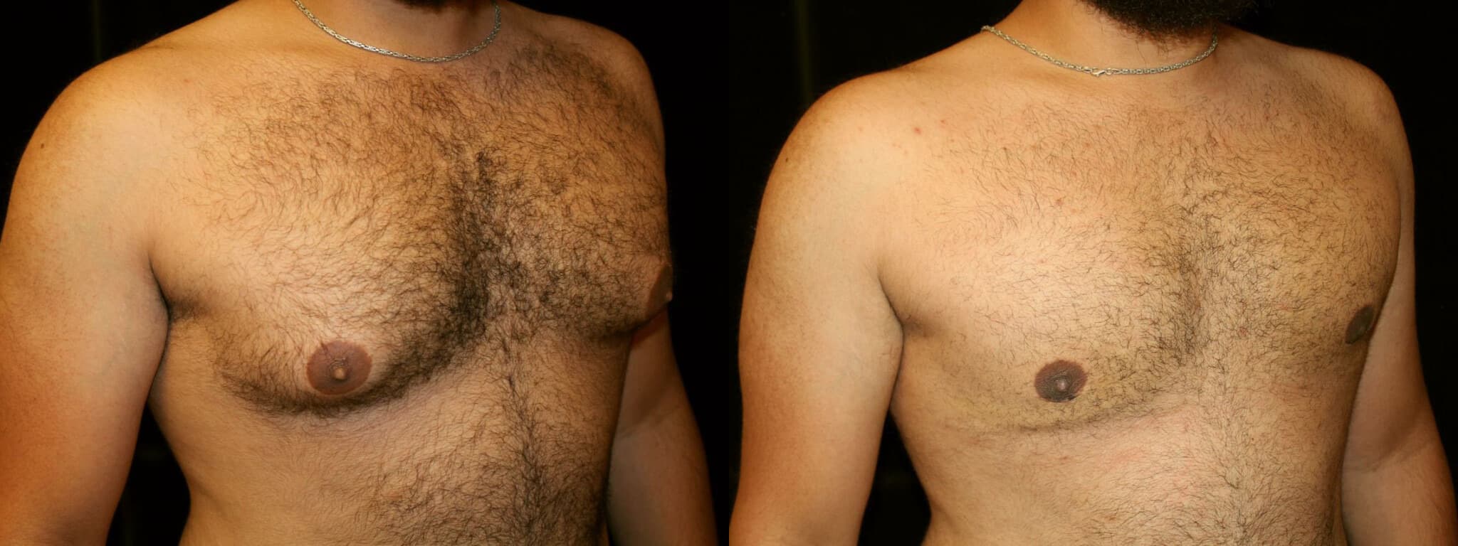 Gynecomastia Patient 20 Before & After Details