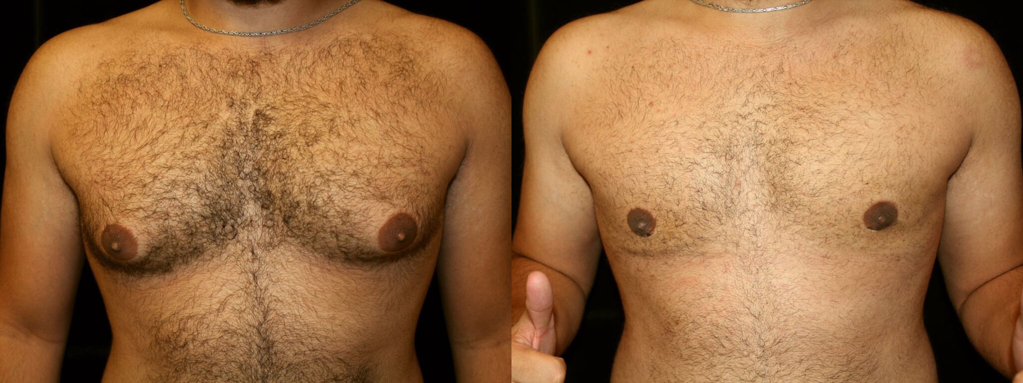 Gynecomastia Patient 20 Before & After