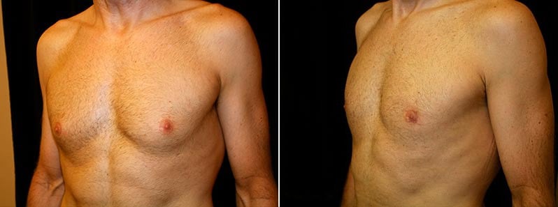 Gynecomastia Patient 17 Before & After Details