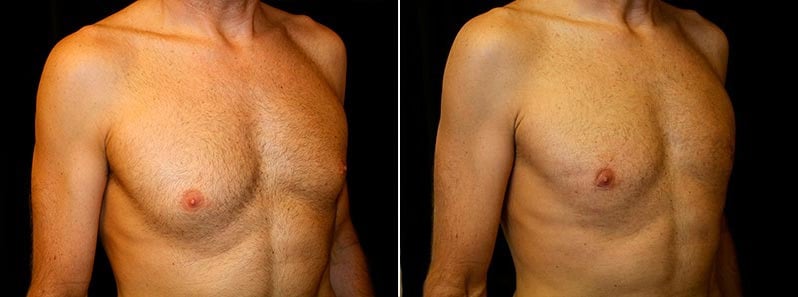 Gynecomastia Patient 17 Before & After Details