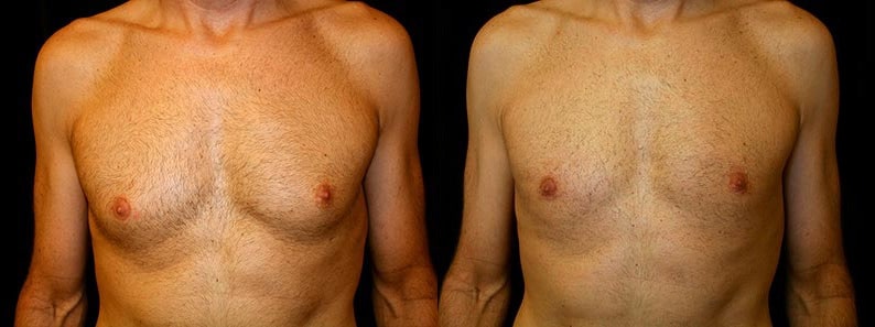 Gynecomastia Patient 17 Before & After