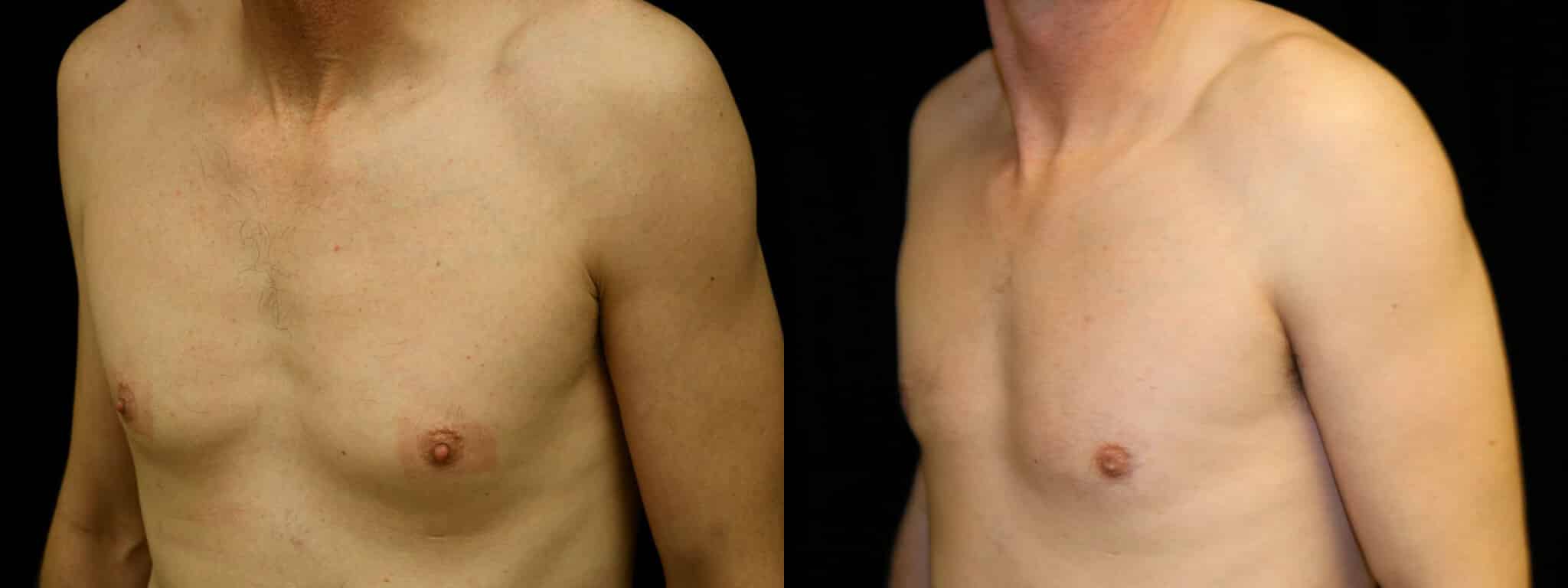 Gynecomastia Patient 19 Before & After Details