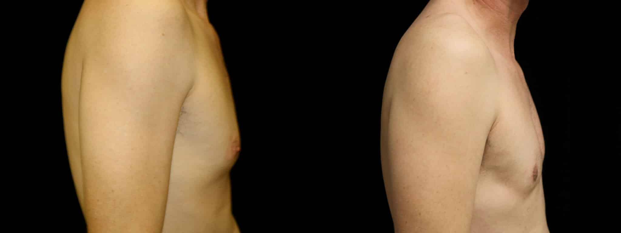 Gynecomastia Patient 19 Before & After Details