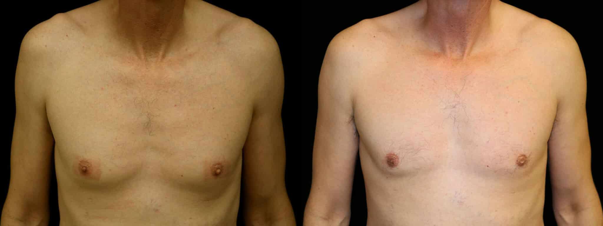 Gynecomastia Patient 19 Before & After