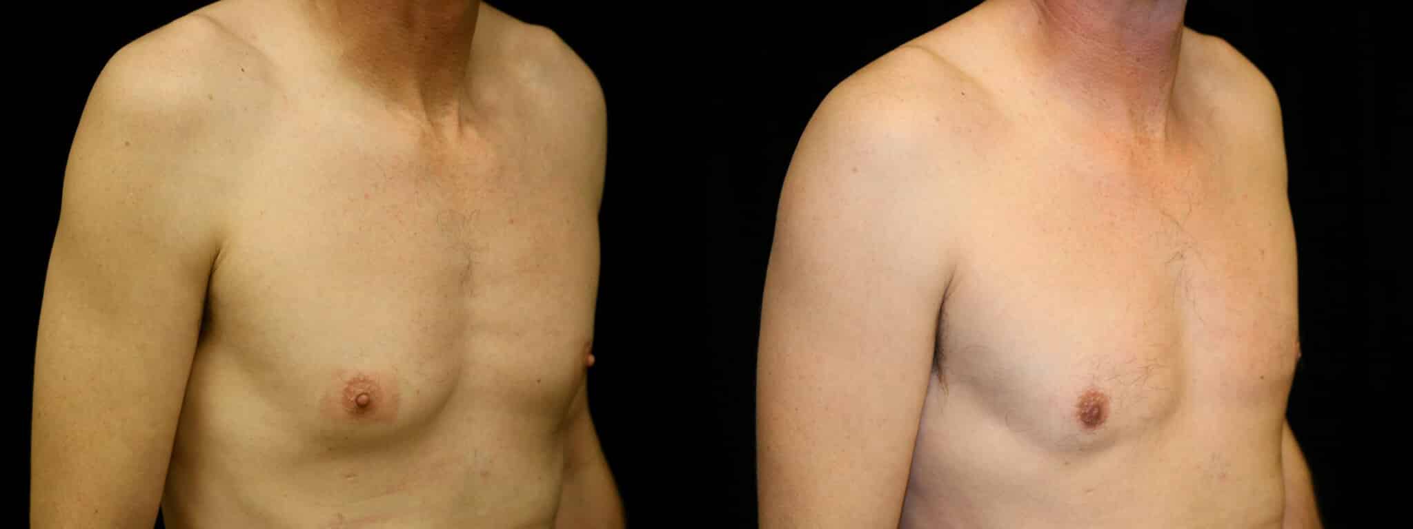 Gynecomastia Patient 19 Before & After Details