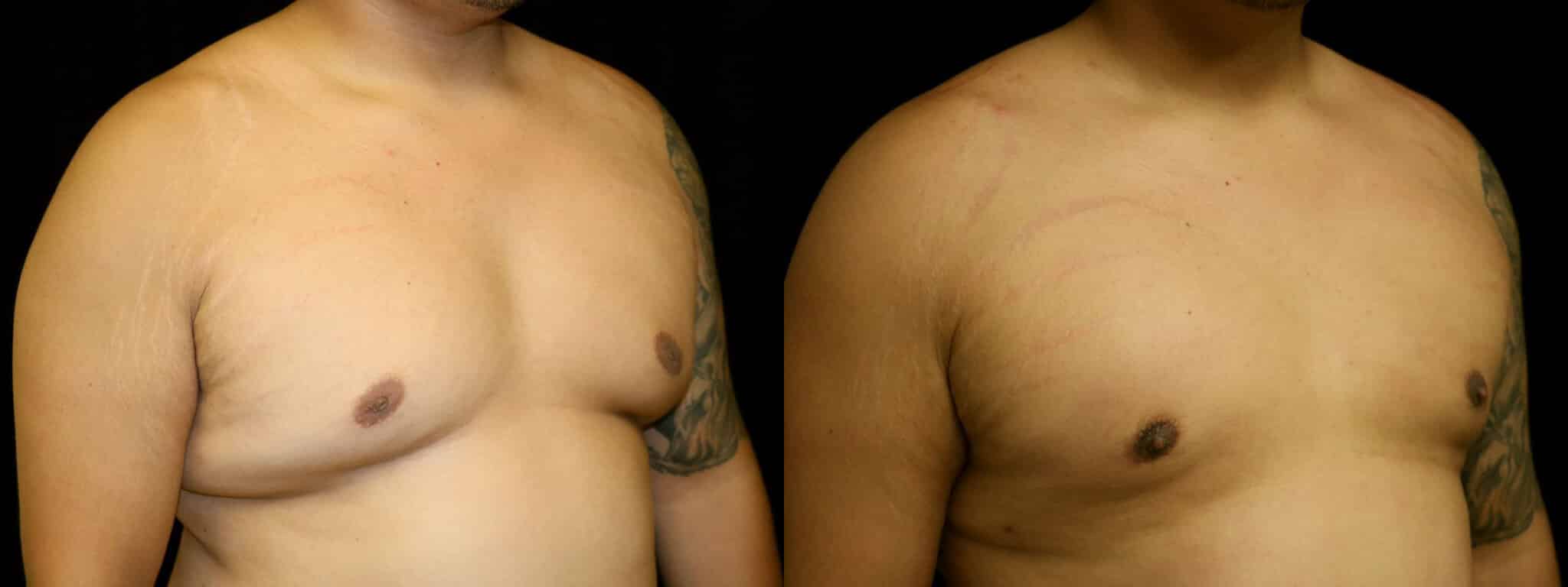 Gynecomastia Patient 7 Before & After Details