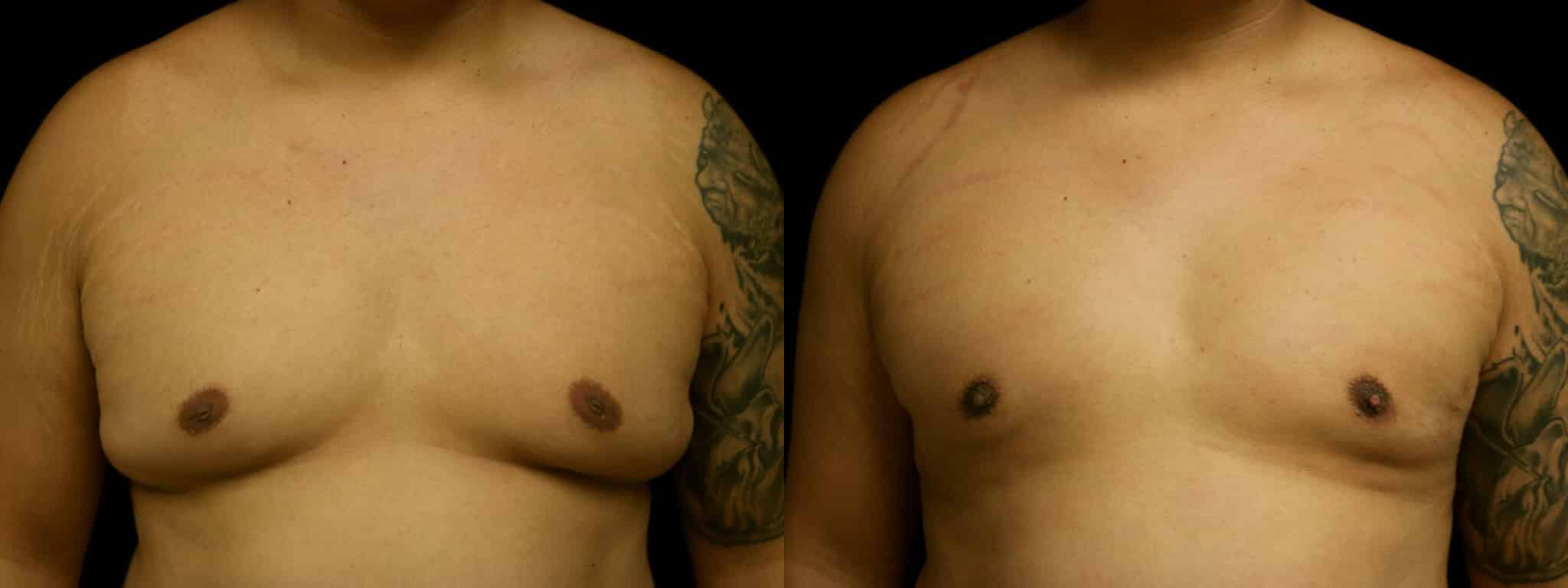 Gynecomastia Patient 7 Before & After