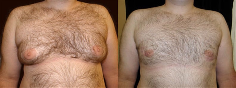 Gynecomastia Patient 12 Before & After