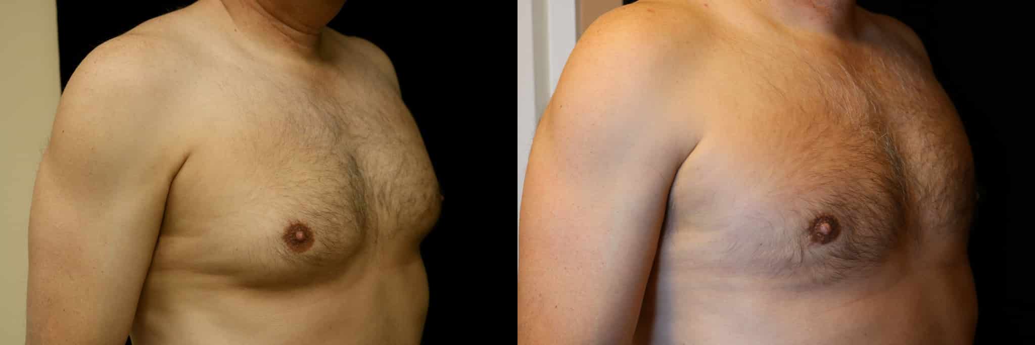 Gynecomastia Patient 6 Before & After Details