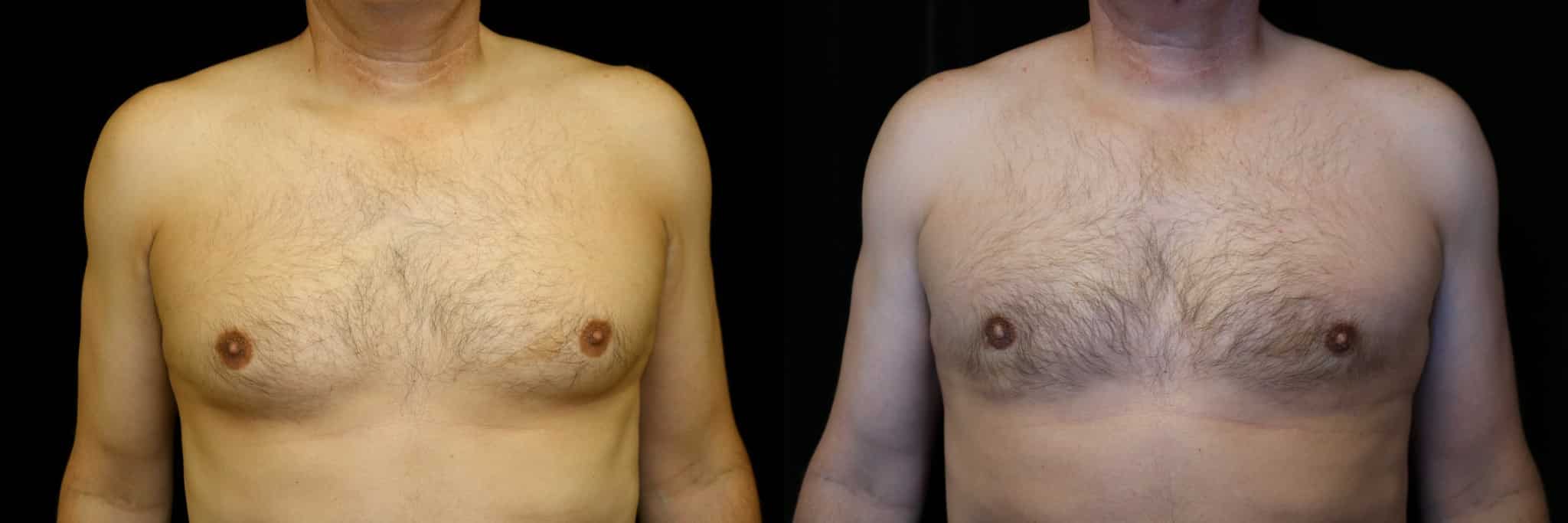 Gynecomastia Patient 6 Before & After