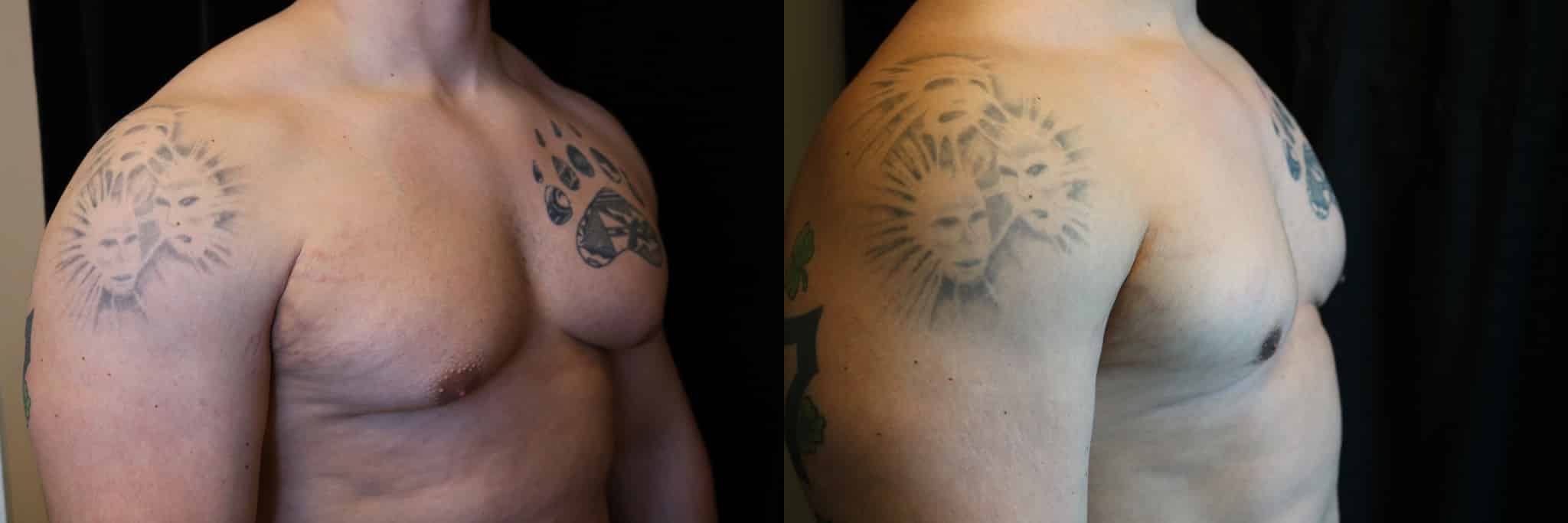 Gynecomastia Patient 13 Before & After Details