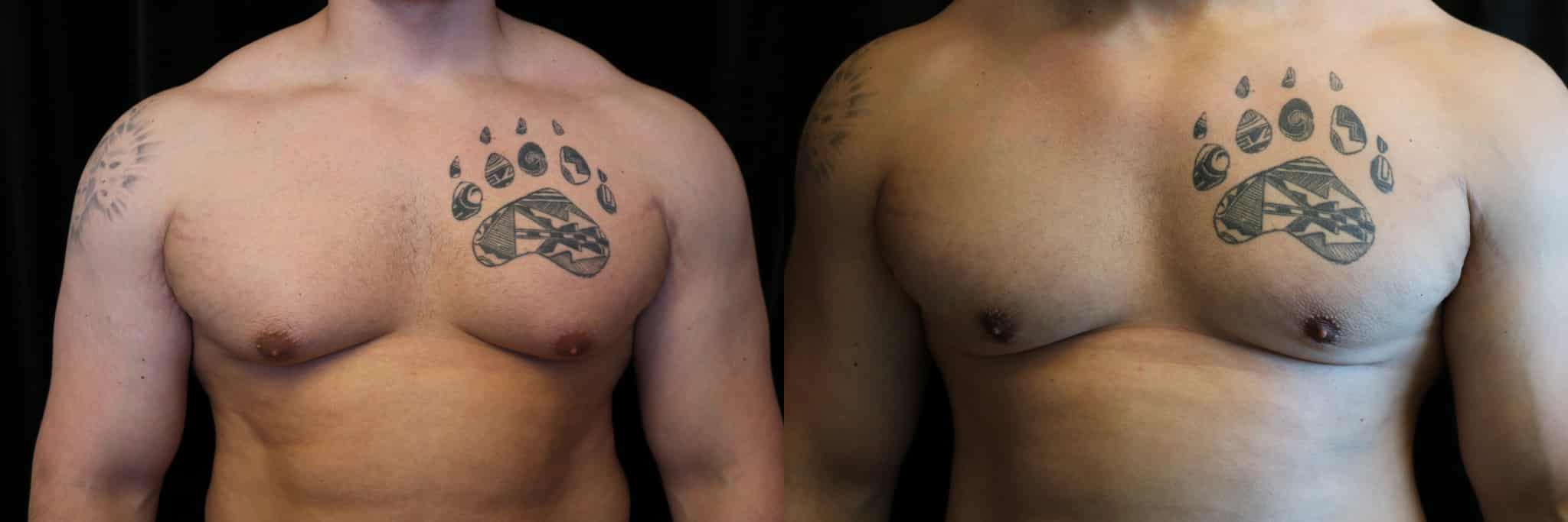 Gynecomastia Patient 13 Before & After