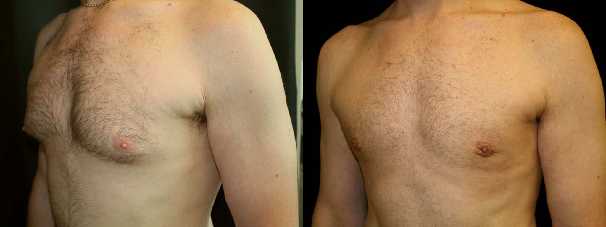 Gynecomastia Patient 7 Before & After Details