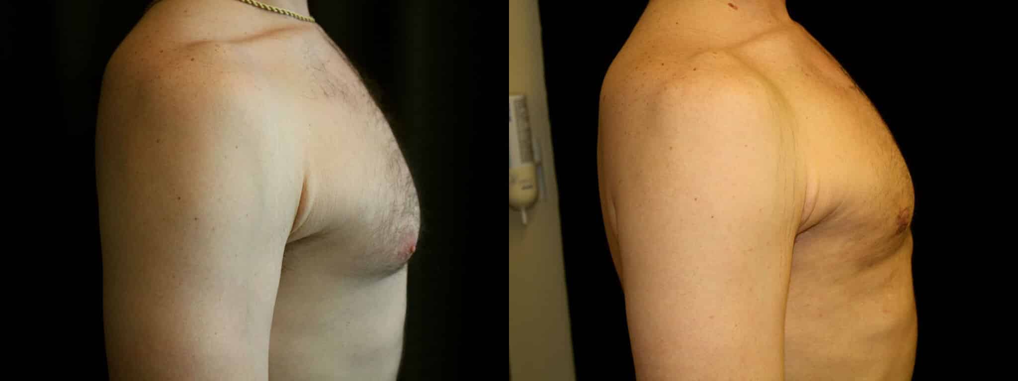 Gynecomastia Patient 7 Before & After Details