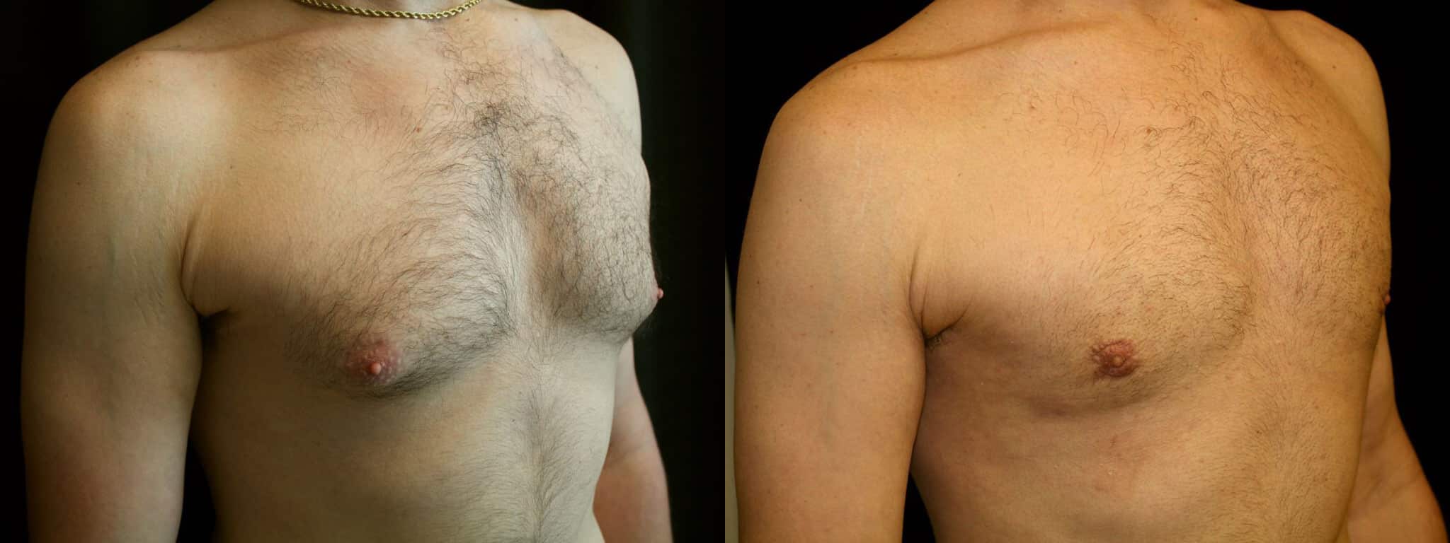 Gynecomastia Patient 7 Before & After Details