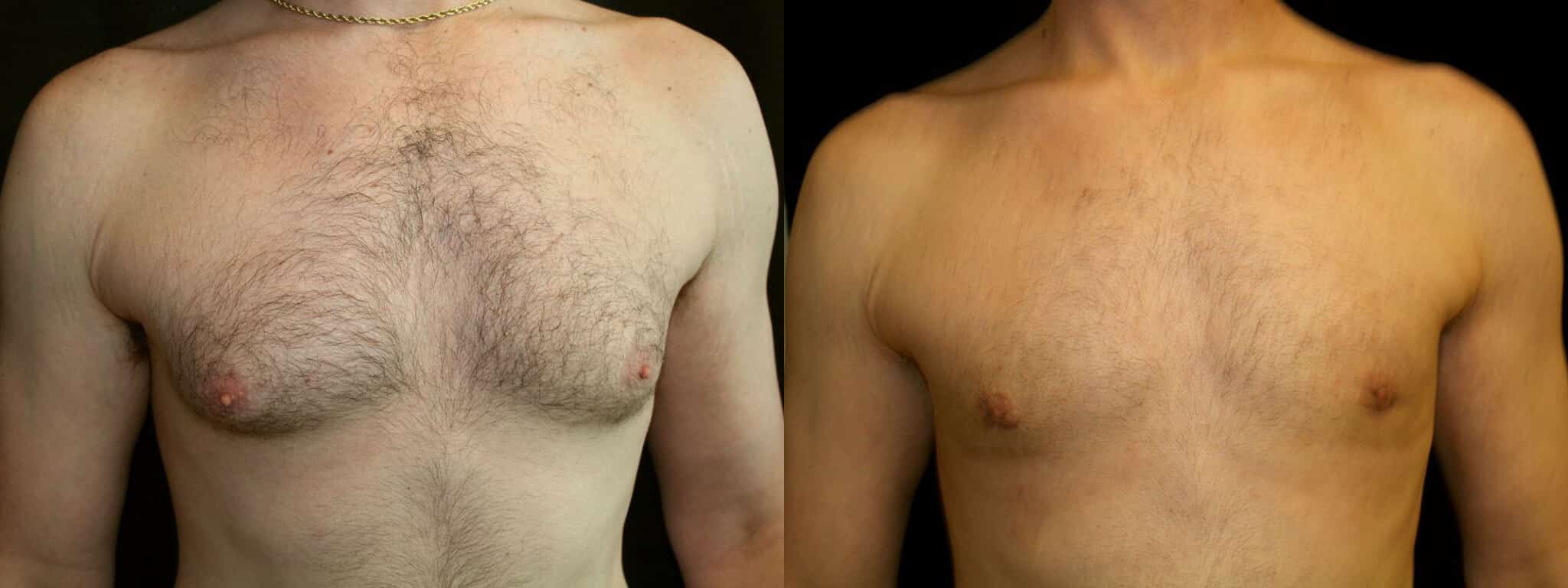 Gynecomastia Patient 7 Before & After