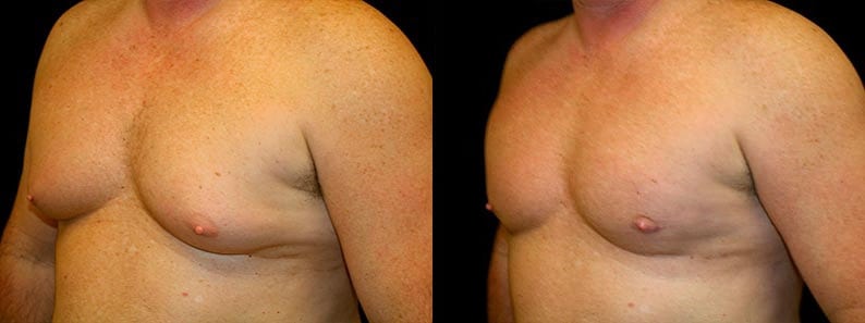 Gynecomastia Patient 20 Before & After Details