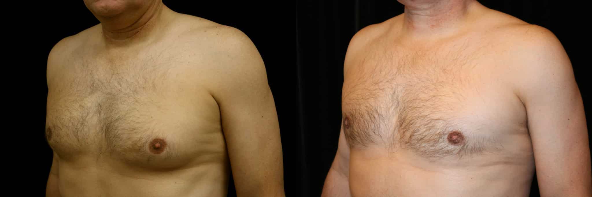 Gynecomastia Patient 6 Before & After Details