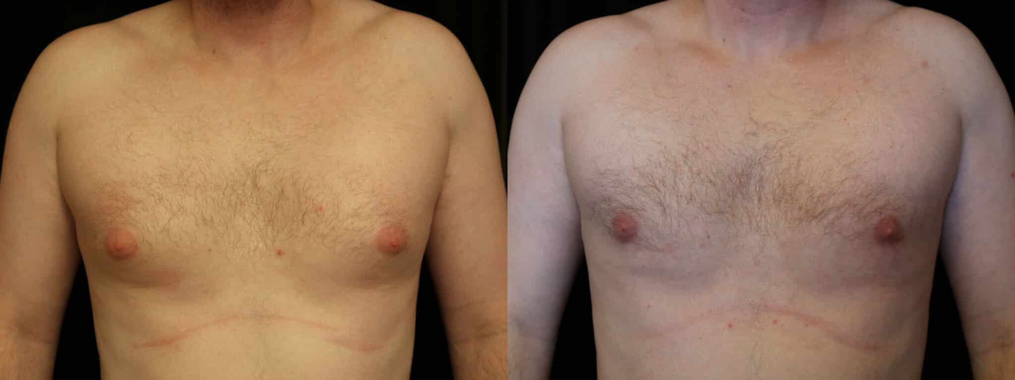 Gynecomastia Patient 18 Before & After