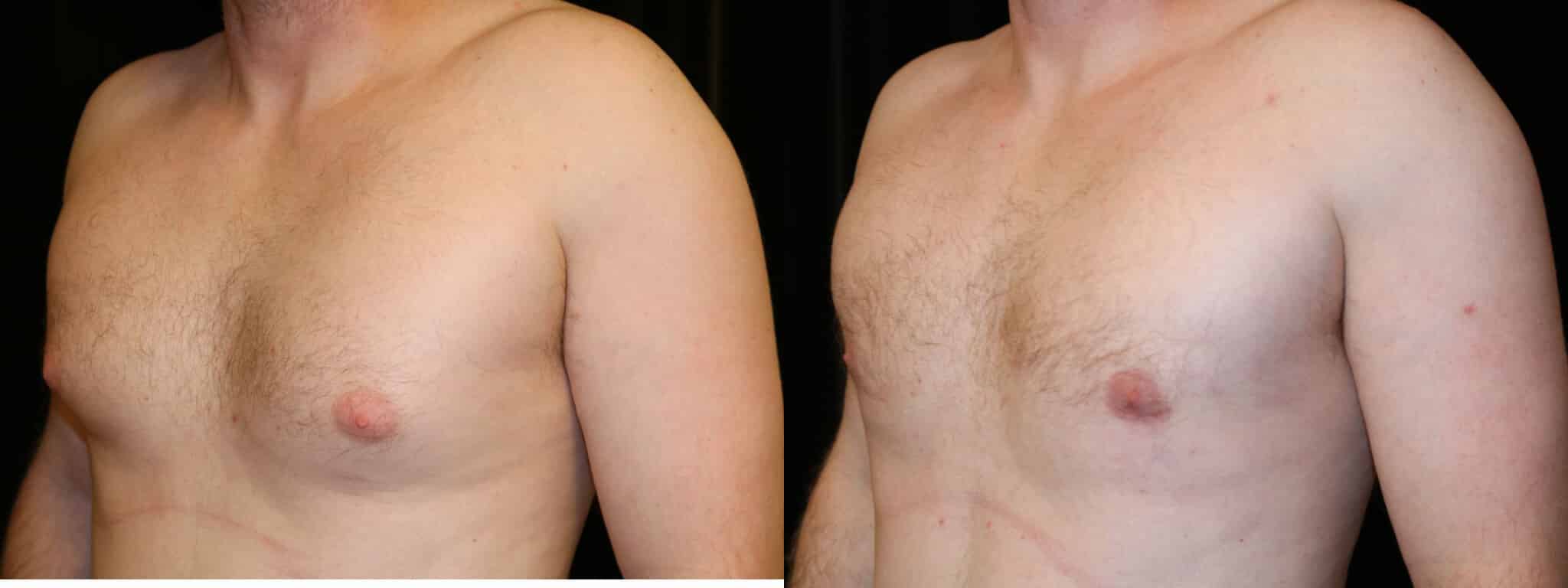 Gynecomastia Patient 18 Before & After Details