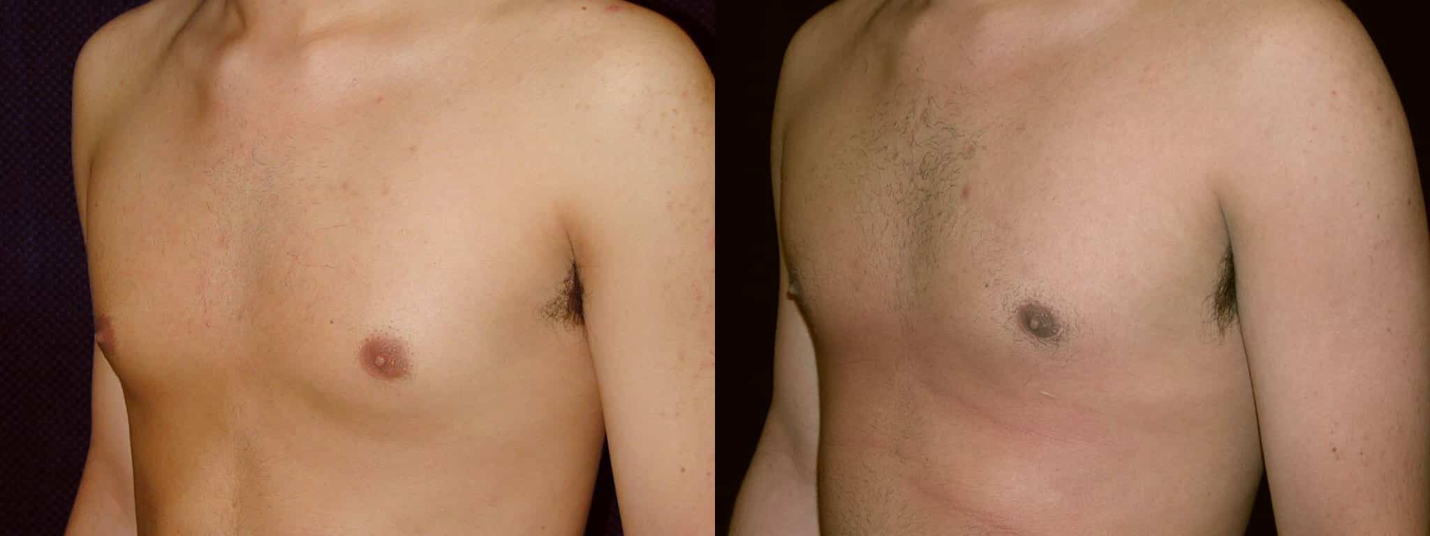 Gynecomastia Patient 12 Before & After Details