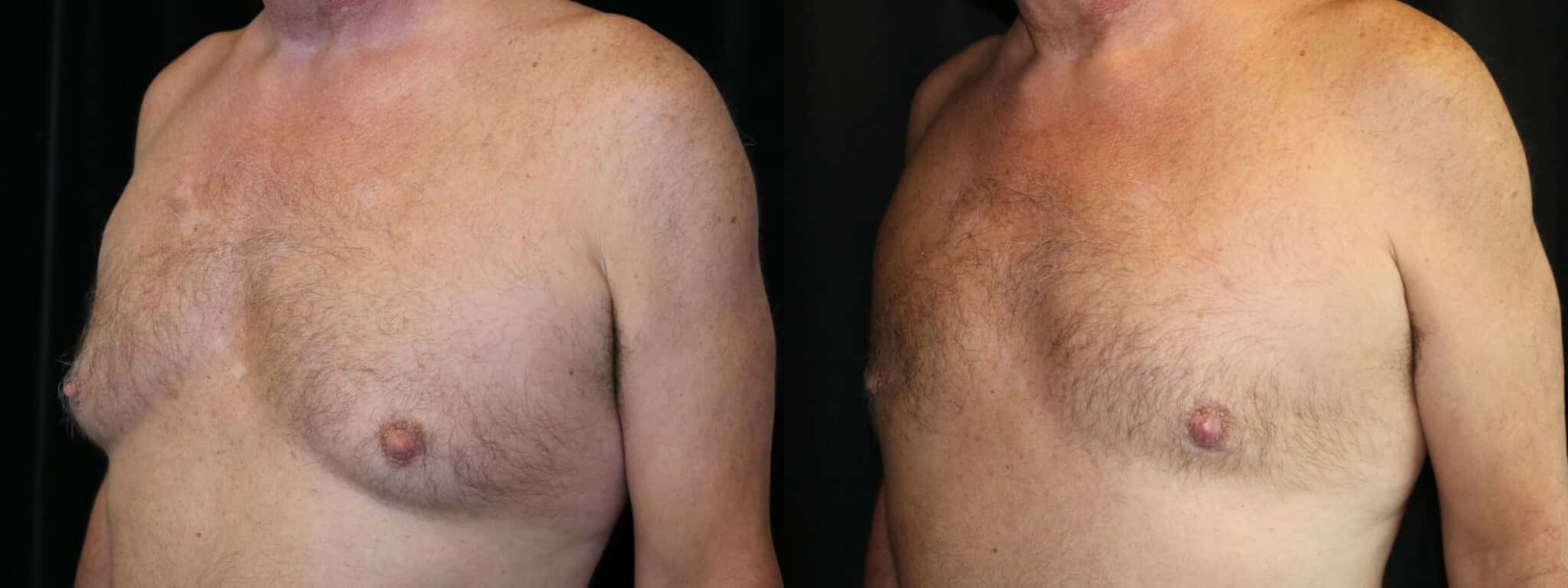 Gynecomastia Patient 9 Before & After Details